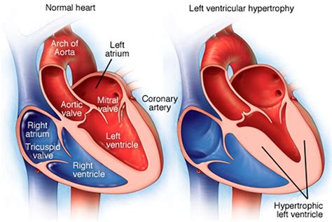 dilated lv|mildly dilated left ventricle symptoms.